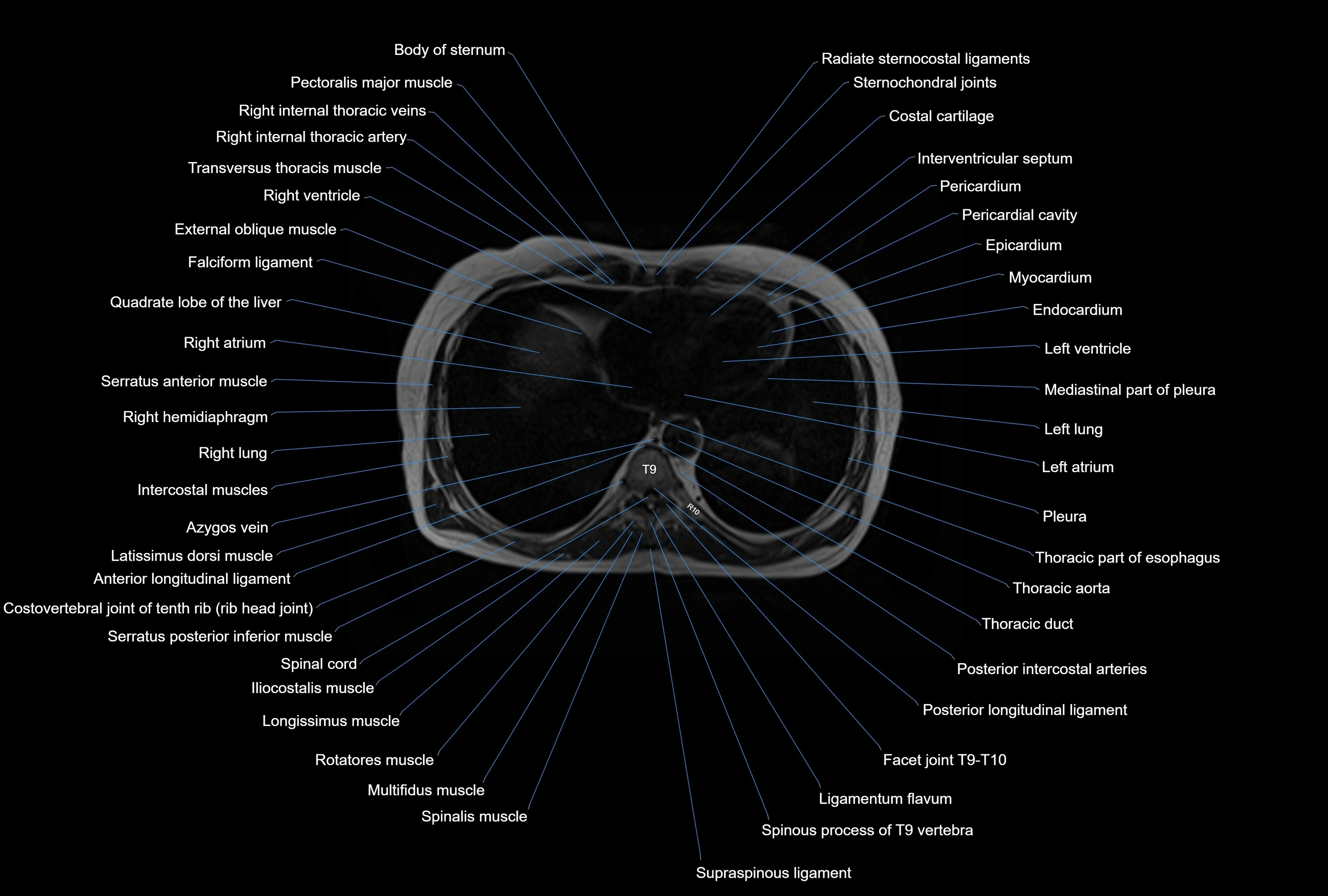 MRI Abdomen axial cross sectional anatomy radiology  image-img-00001-00002.webp